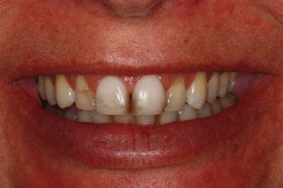 Smile with cavities front teeth before treatment