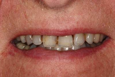 Yellow stained teeth  with cavities before treatment