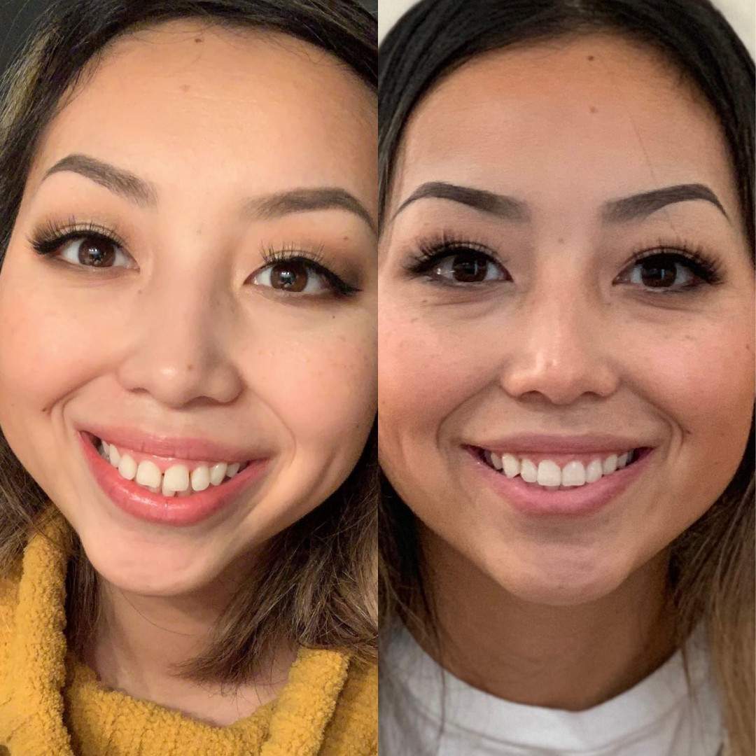 Asian woman with spaces between teeth before to straight beautiful teeth after