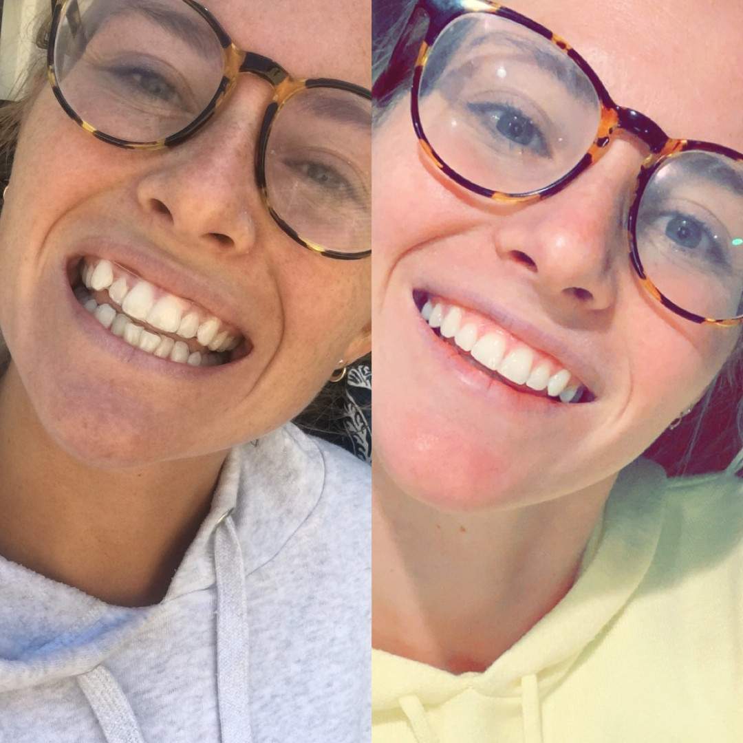 before and after of a woman with glasses and teeth that overlaps to a straight, healthy smile